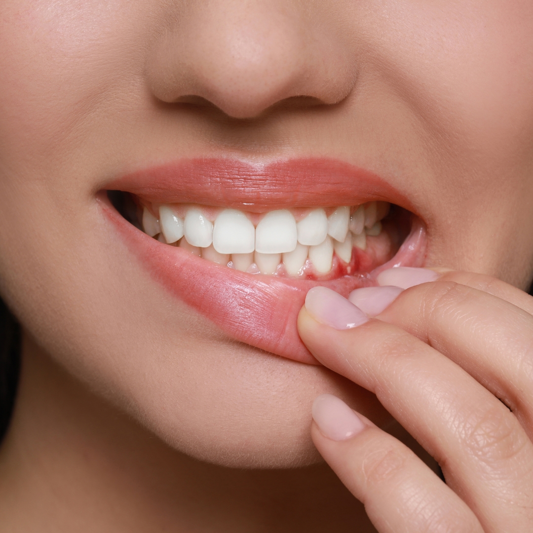 How to Heal a Hole in Your Gum Quickly and Safely?
