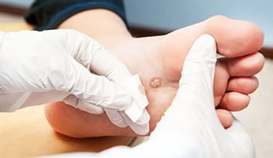 Wart Removal Techniques Dermatologists Recommend