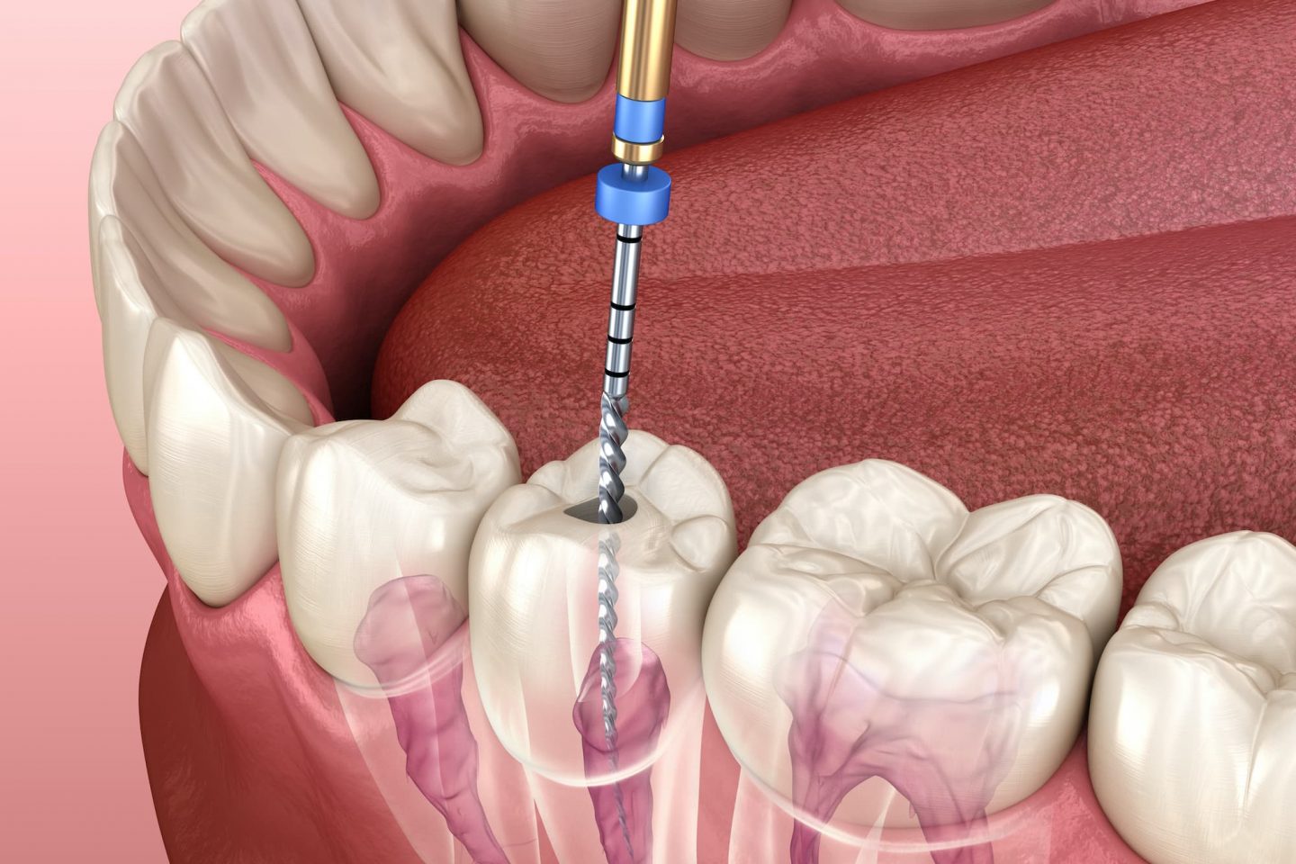 How Root Canal Treatment Preserves the Tooth Structure