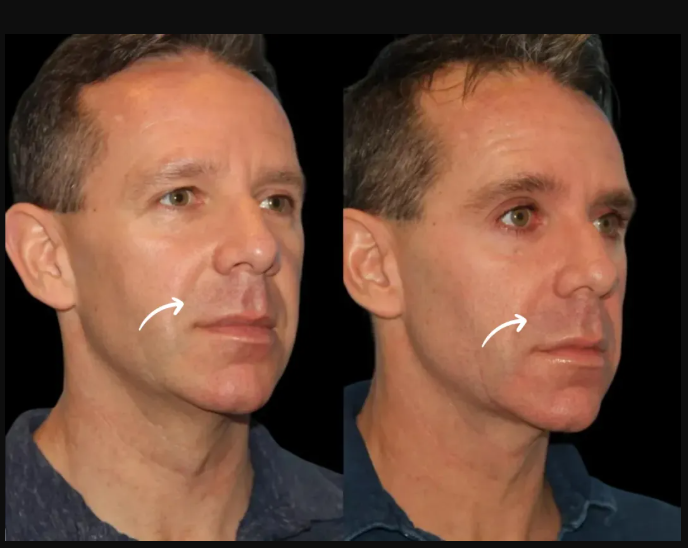 Celebrities Who Chose Sculptra Fillers at Best Aesthetic Clinics in Dubai