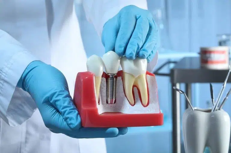 Reasons to Choose All on 4 in Brisbane for a Permanent Smile Solution