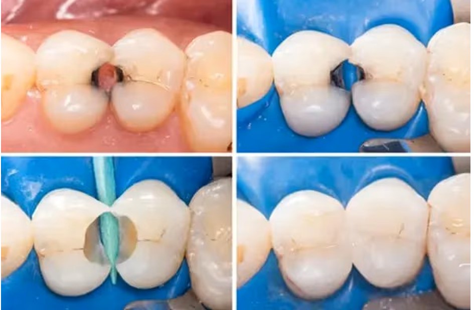 Cracked Tooth Restoration: Restoring Your Tooth and Comfort