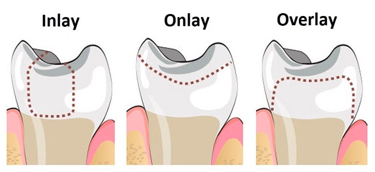 Not Every Cavity Needs a Filling Here’s a Smarter Alternative
