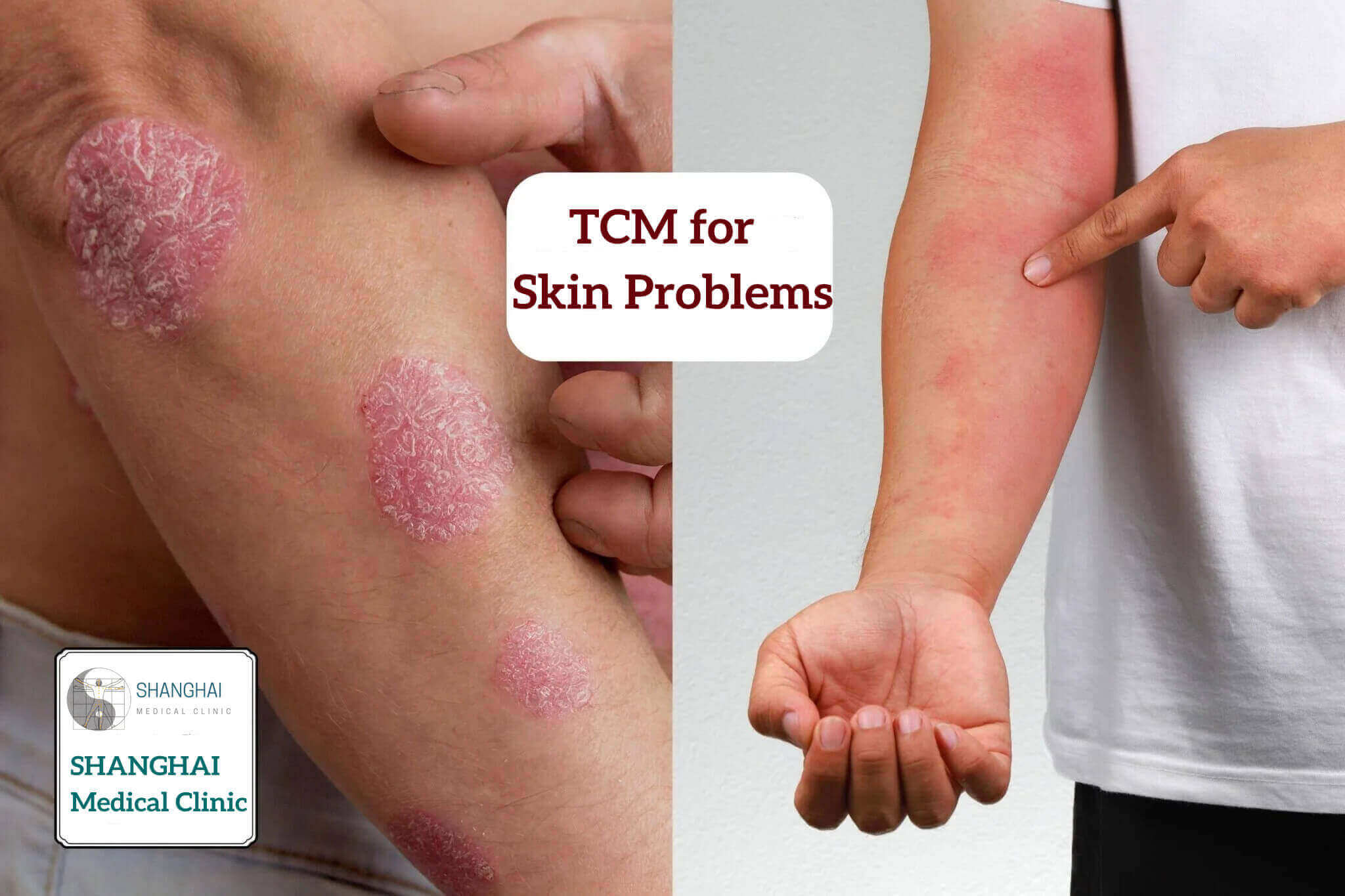 6 Reasons to Consider Chinese Medicine for Skin Disorders