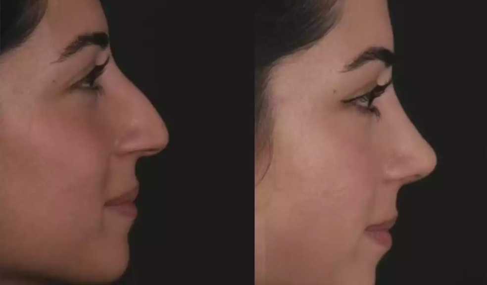 Expert Opinions: Best Doctors in Dubai on Septoplasty Benefits