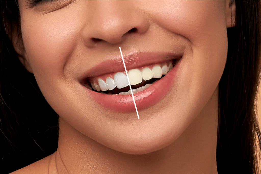 Say Goodbye to Yellow Teeth – Hello to a Dazzling Smile
