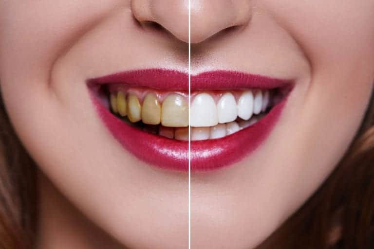 Let Your Smile Shine with Safe & Effective Whitening