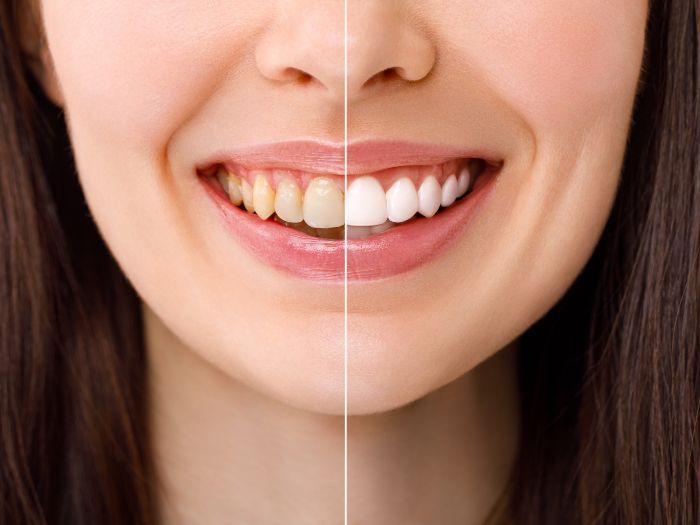 Transform Your Smile with Advanced Whitening Technology