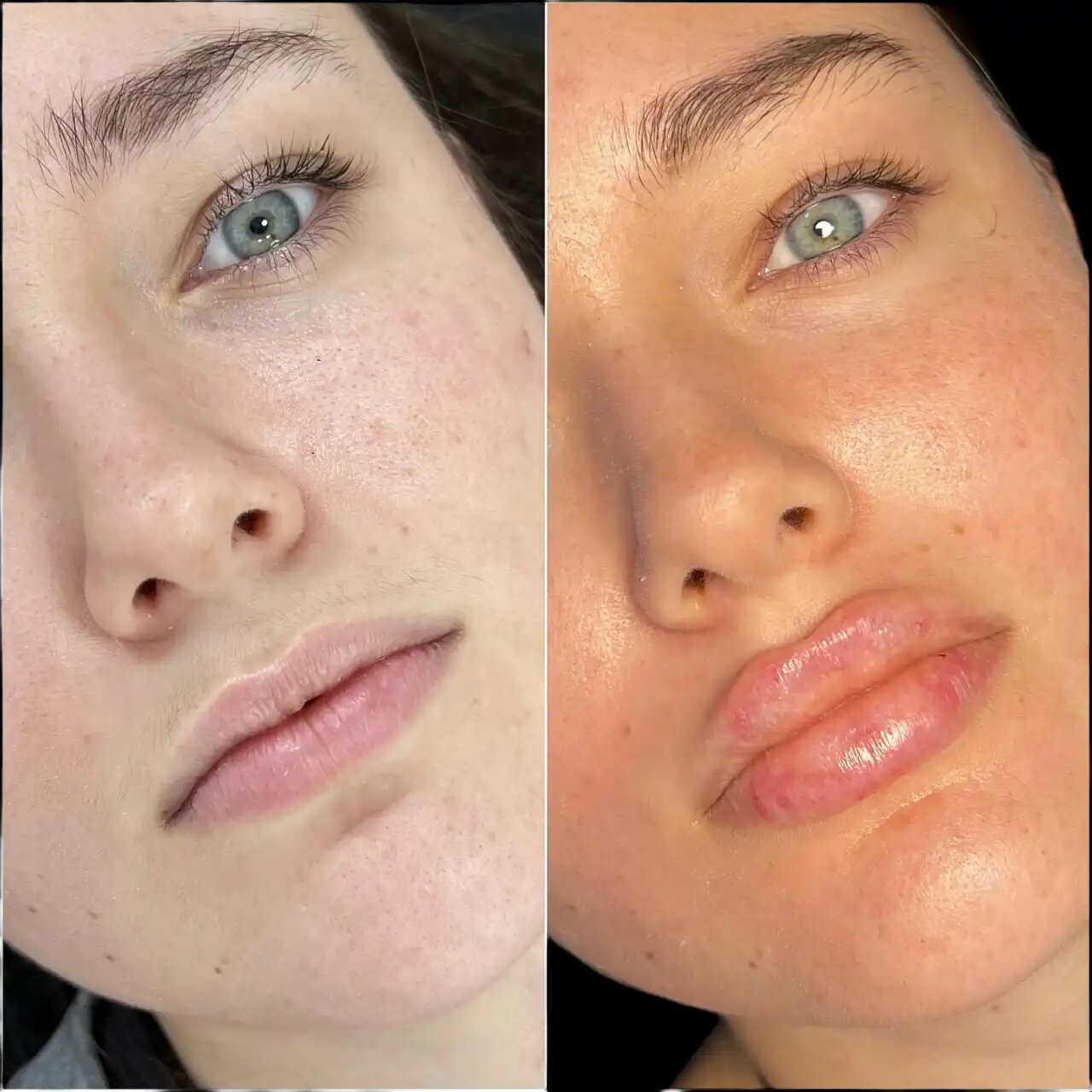 Best Plastic Surgeons In Dubai For Fillers: Combining Procedures For Optimal Results