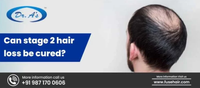 Stage 2 Hair Loss Treatment | Best Hair Transplant in Delhi