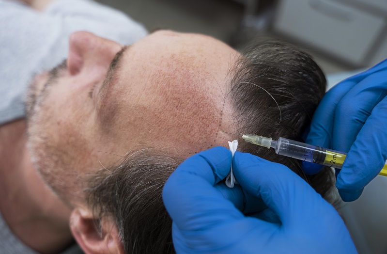 How to Choose the Best Hair Transplant Doctor in Kanpur