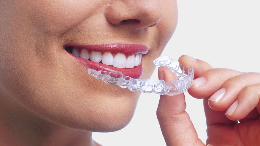 Your Step-by-Step Guide to Getting Invisible Braces in Chula Vista
