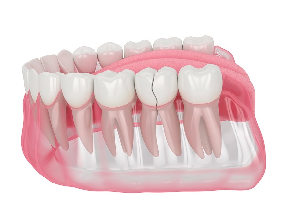 How to Know If You Have a Cracked Tooth and What to Do About It