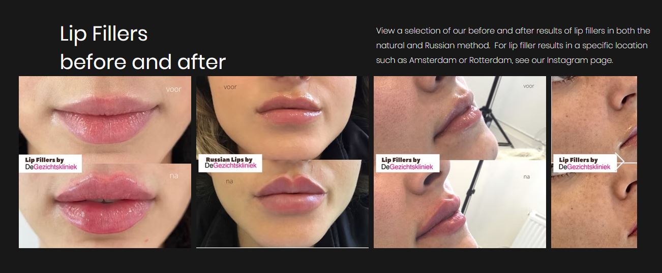 Lip Filler Aftercare: What Should You Really Do (and Avoid) for the Best Results?