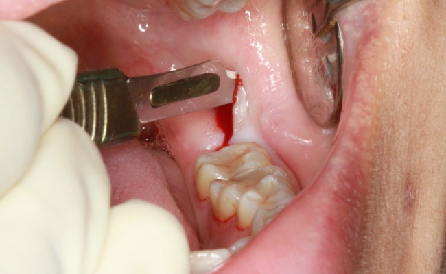 Chăm sóc sau nhổ răng khôn đúng cách: Bí quyết giúp vết thương nhanh lành