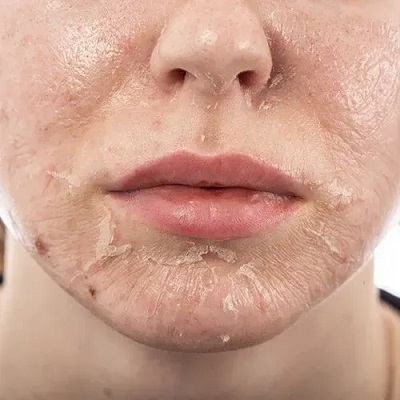 Does TCA Peel Offer Permanent Skin Improvements?