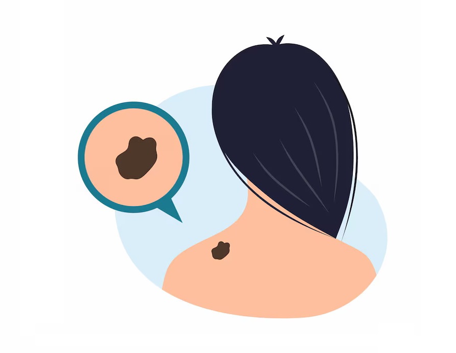What is the 7-Point Checklist for Melanoma?