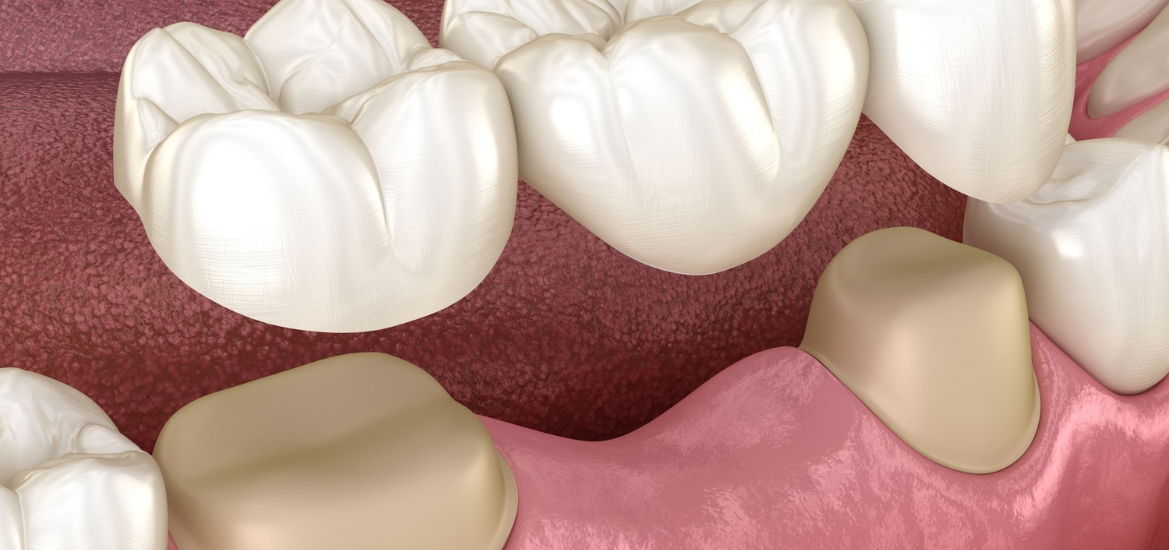 Can Dental Crowns Improve Your Bite and Chewing Efficiency?