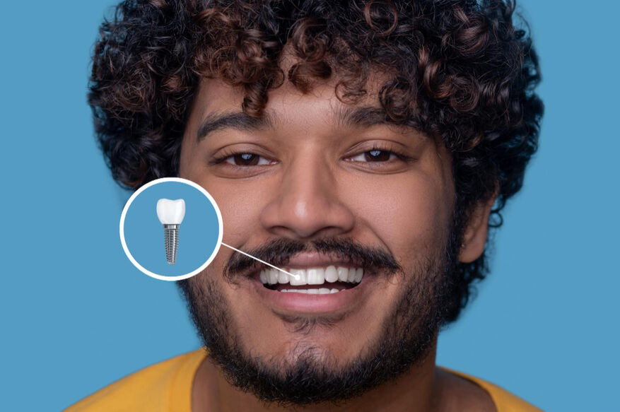 Mistakes To Avoid After Dental Implants