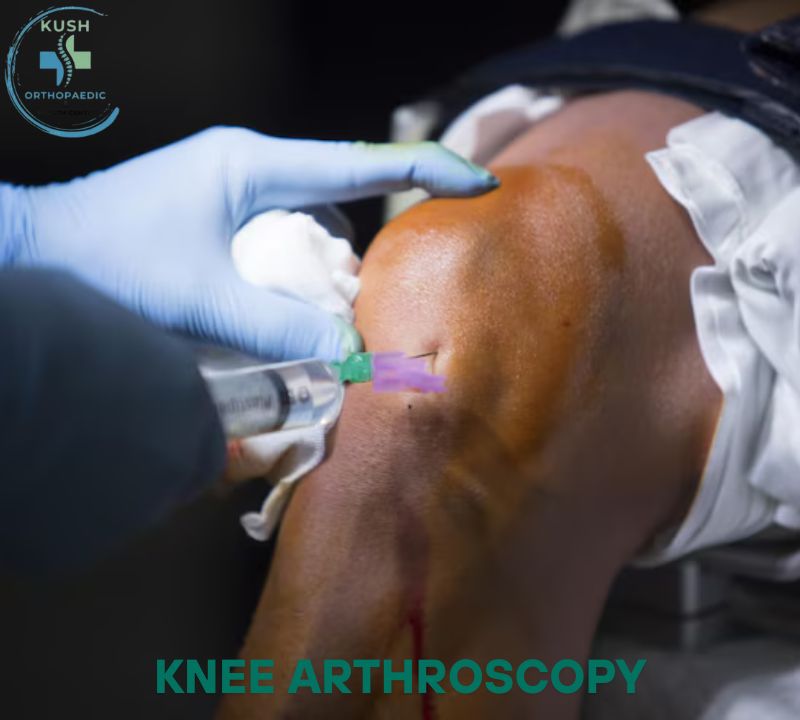 Knee Arthroscopy: Symptoms, Advantages, and Treatment