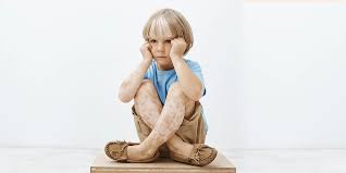How Do White Patches from Vitiligo Affect a Child’s Confidence?