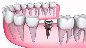 Trồng răng implant giá bao nhieu? Chi tiết chi phí và giải pháp tiết kiệm cho người mất răng