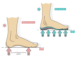 How ProFunction Orthotics Are Changing Lives One Step at a Time