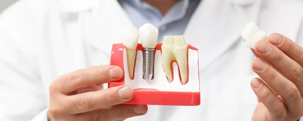 How Same-Day Dental Implants Work: Step-by-Step Breakdown