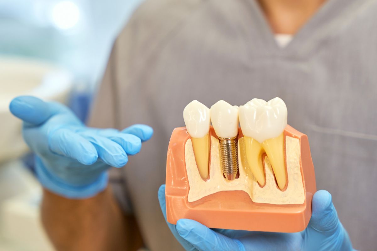 Single vs. Multiple Dental Implants: Which One Do You Need?