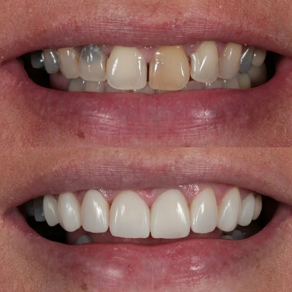 Can you remove stains from composite bonding?