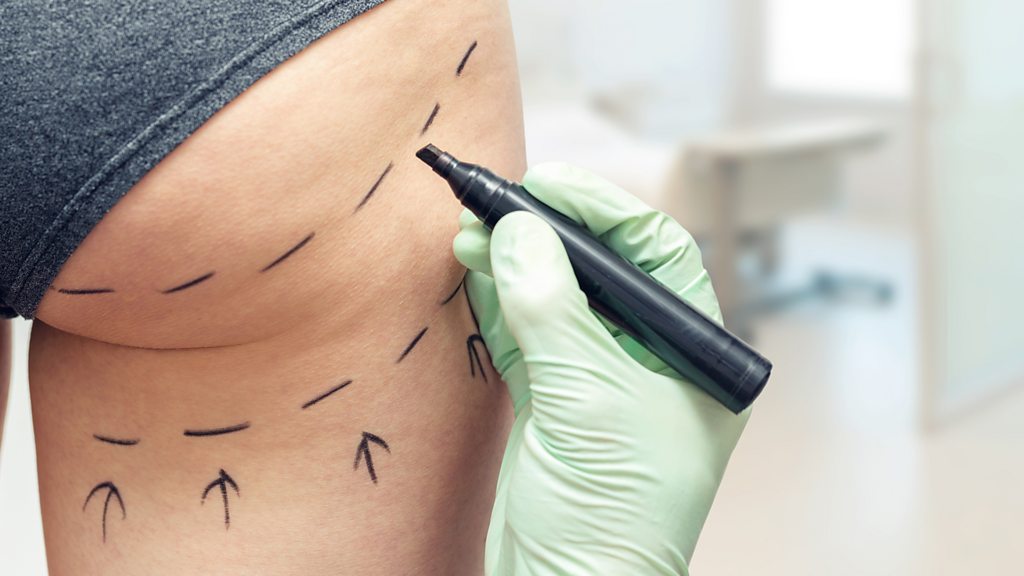 The Non-Surgical BBL: A Safer Way to Sculpt Your Curves