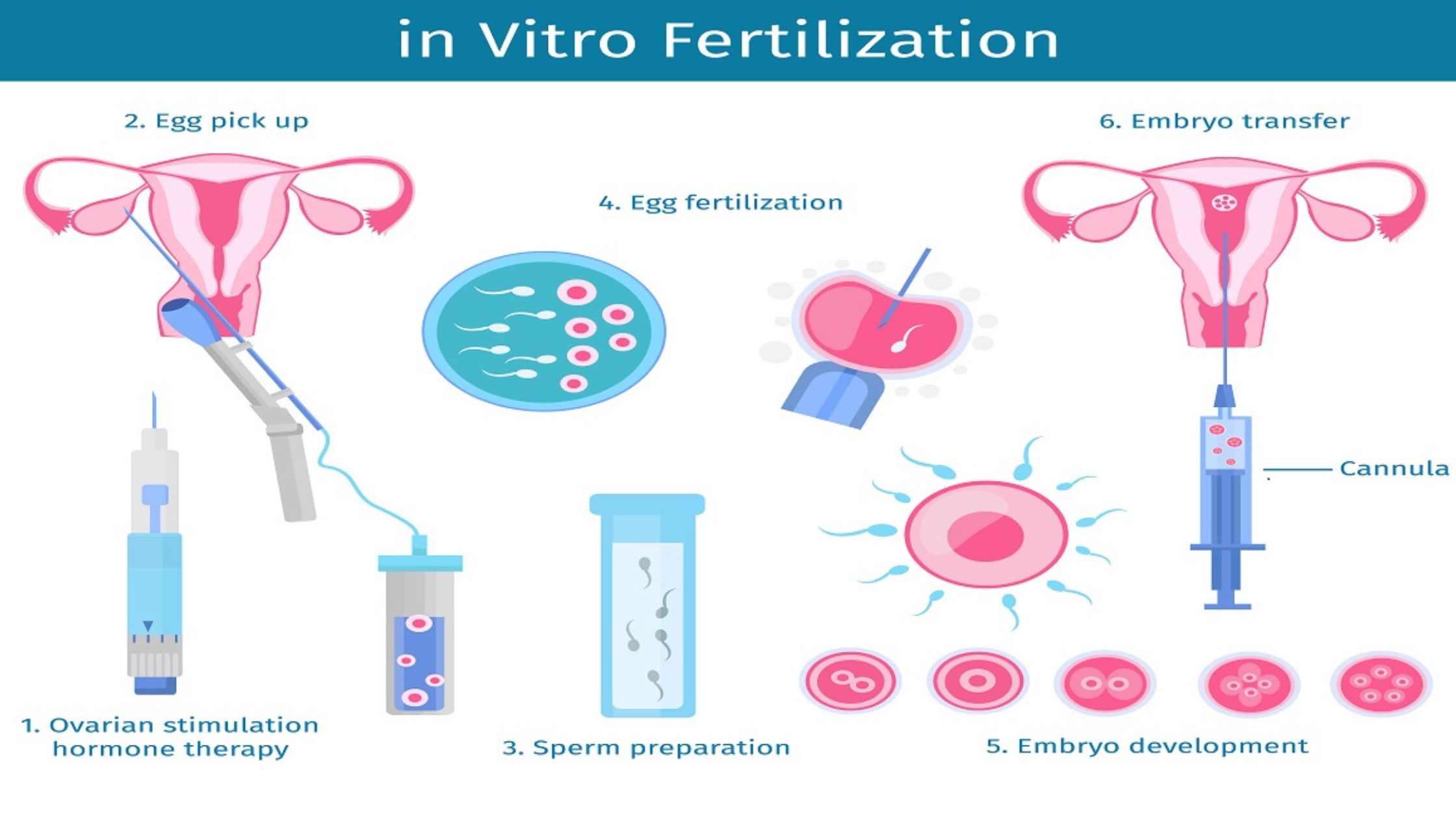 Comprehensive Guide to IVF Treatment in Delhi at Sunrise Hospital