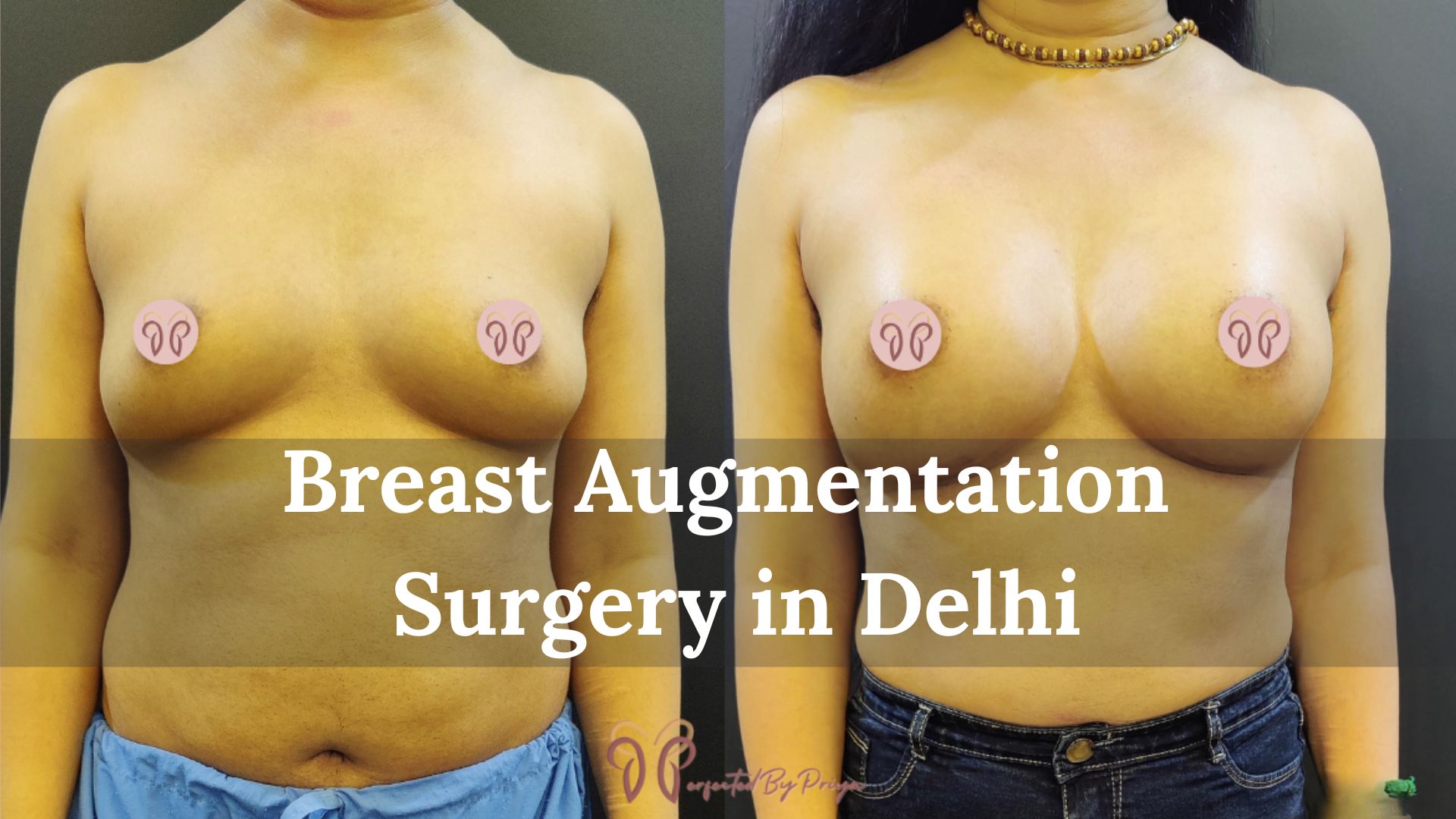 Breast Augmentation Surgery in Delhi – Enhance Your Beauty with Expert Care