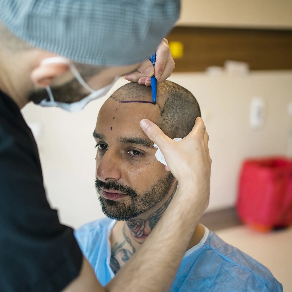 When can I go out normally after hair transplant?