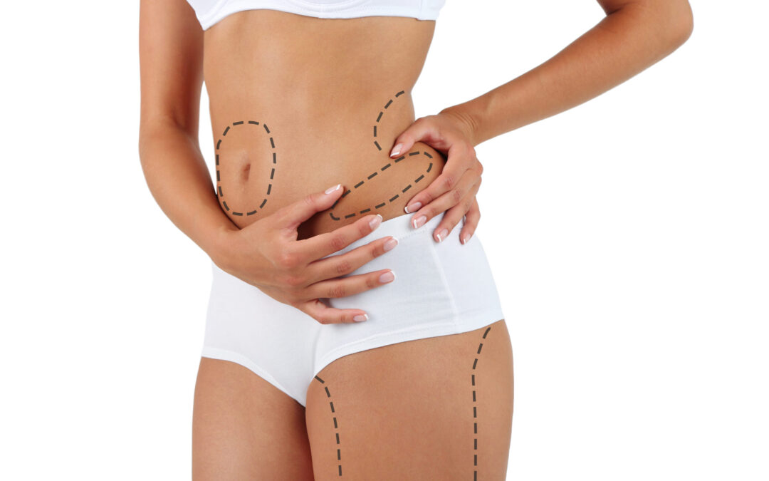 Can fat come back after liposuction?