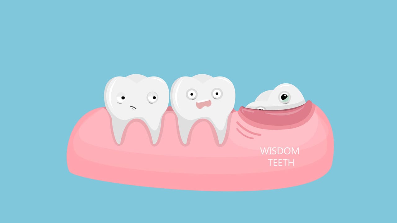 5 Ways to Take Care of Your Wisdom Teeth!