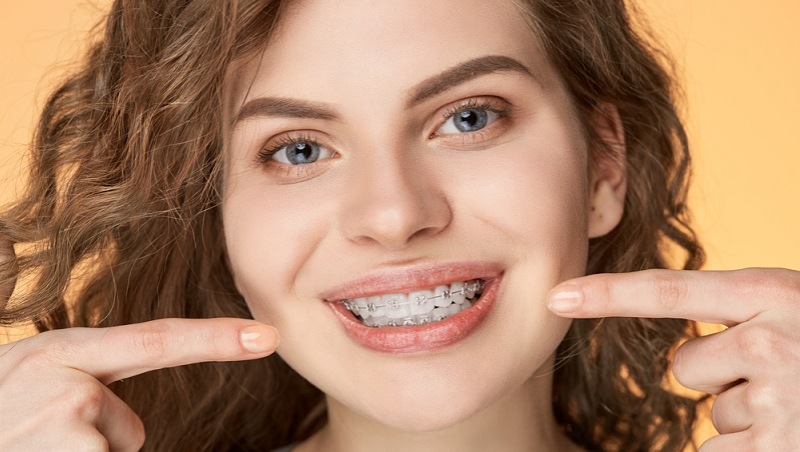 Price of Braces in Lahore & What Influences the cost of Braces
