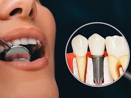 Is the Dental Implant Procedure Painful? Honest Answers to Common Concerns