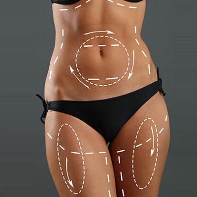 Liposuction in Riyadh: Define, Contour, Transform