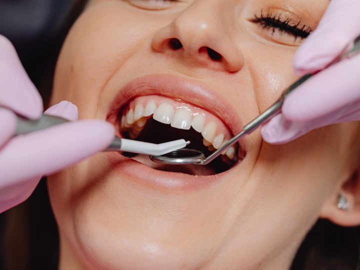 Dental Implants: A Permanent Solution for Missing Teeth
