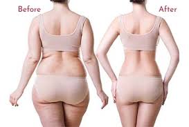 Comprehensive Guide to Body Contouring Surgery in Gurgaon – Cost, Procedure & Benefits by Dr. Amit Gupta