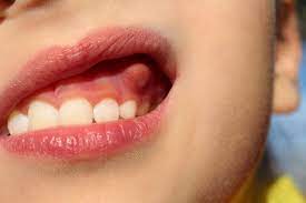 Gingivectomy for Periodontitis: A Clinical Perspective