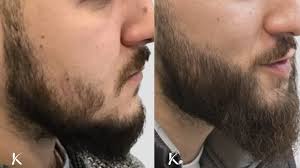 How a Beard Hair Transplant Works: Step-by-Step Process