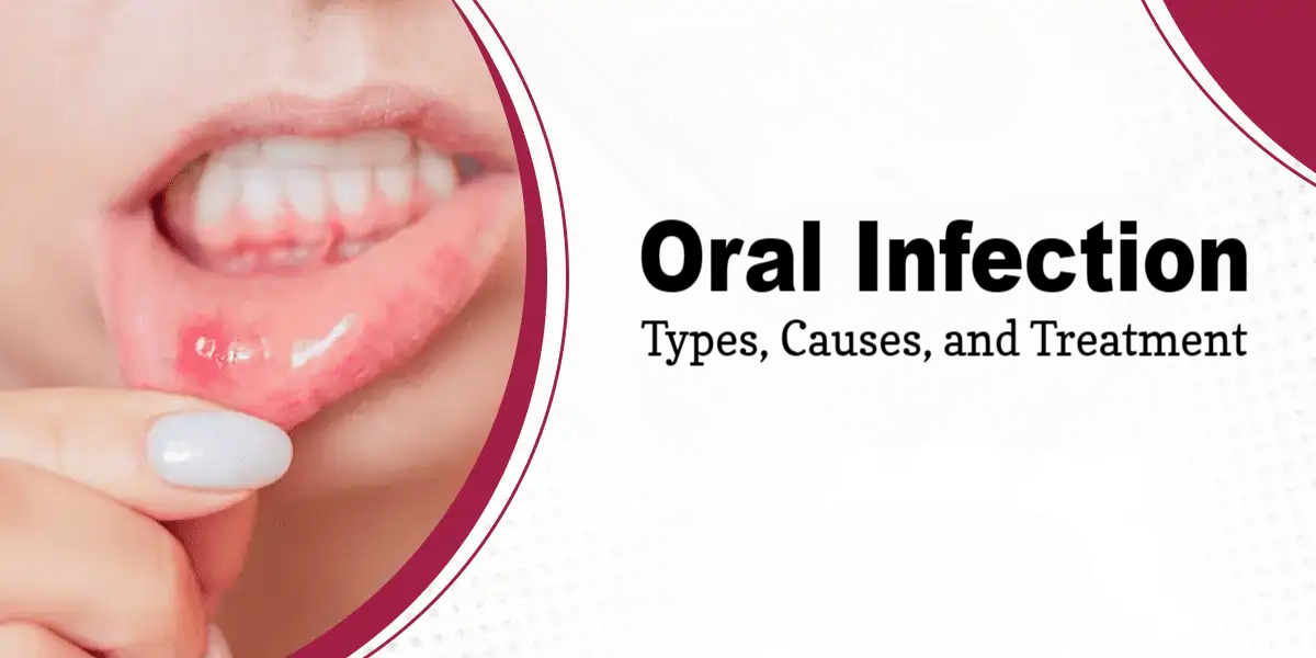 Oral Infection: Types, Causes, and Treatment