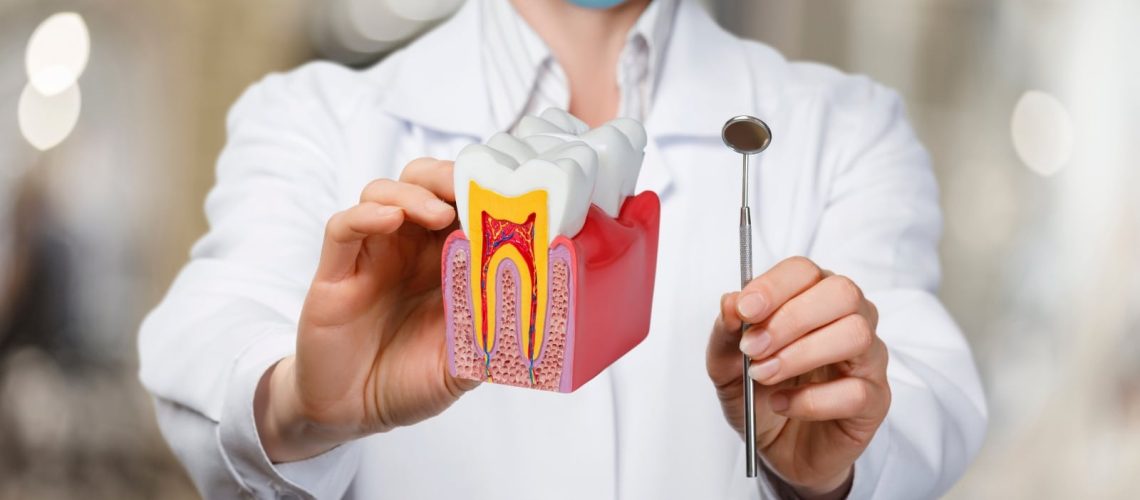 Why Saving Your Natural Tooth with a Root Canal is the Best Choice