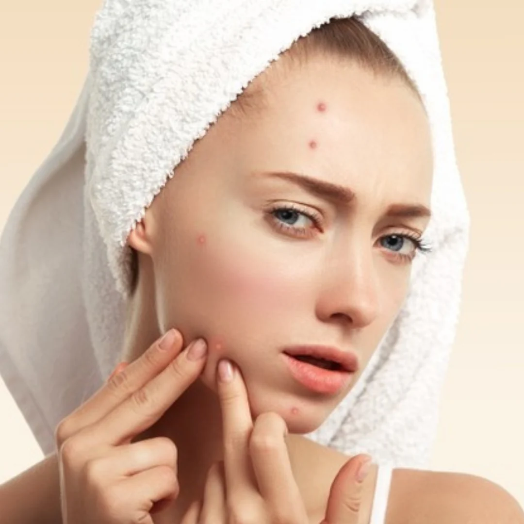 Hidden Costs of Acne Scar Treatments in Islamabad: What You Need to Know
