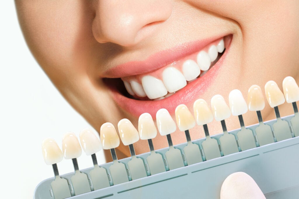 How E-max Veneers Are Made: A Look Behind the Smile