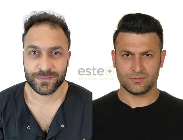 Hair Transplant Before and After: Real Transformations You Must See