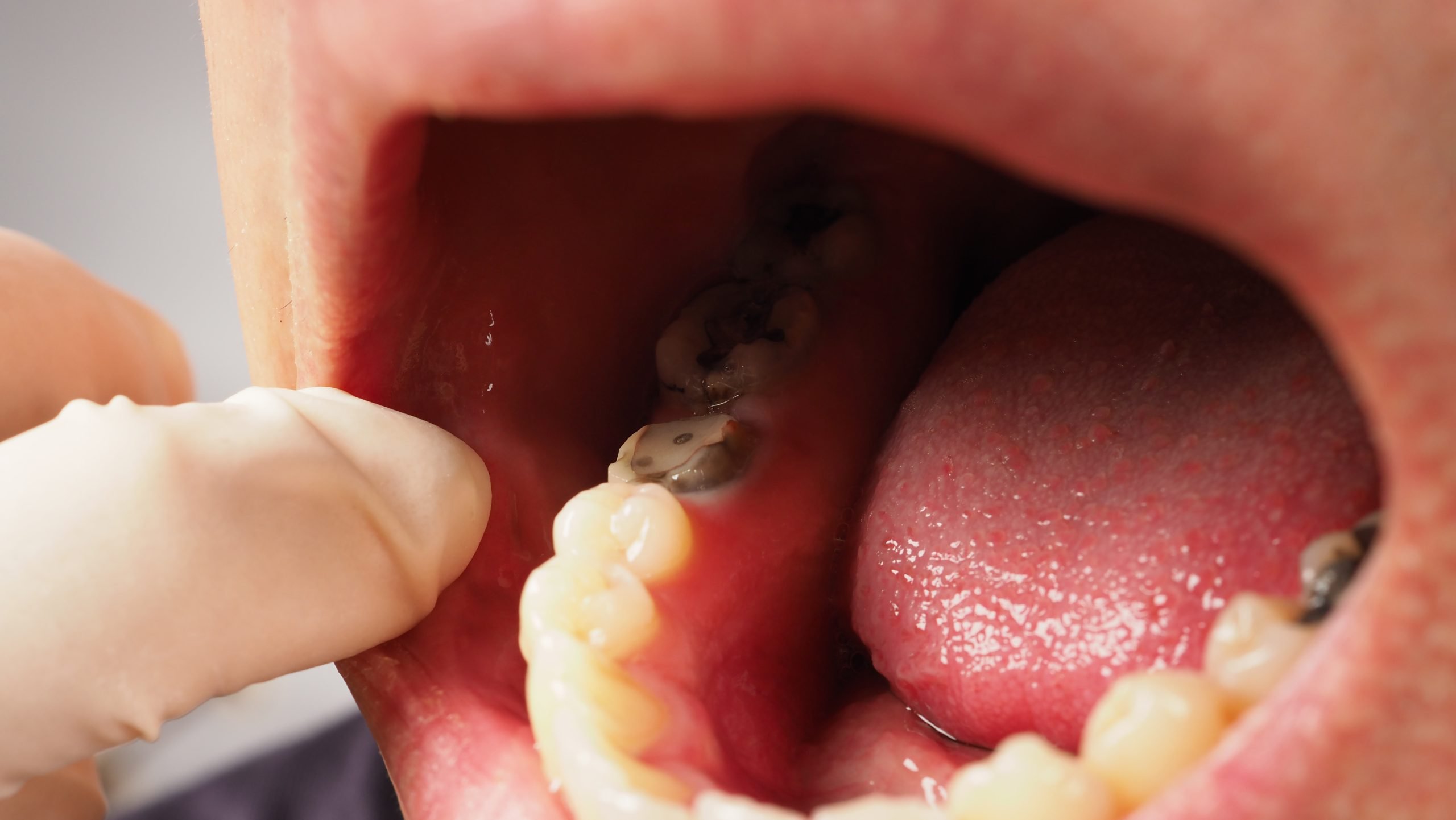 Is There an Alternative to Dental Fillings?