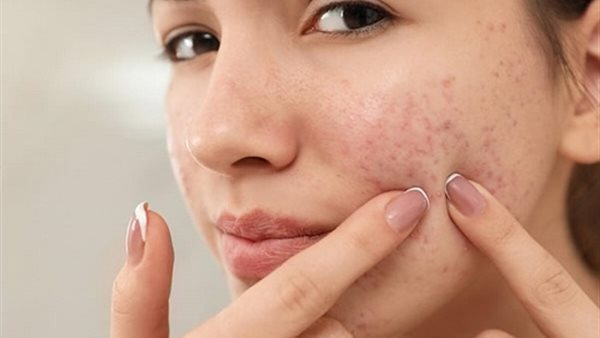 تجارب واقعية من الرياض: كيف تخلصت من البثور خلال شهر؟